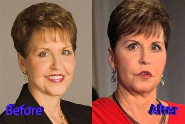 Joyce Meyer Plastic Surgery A Huge Flop Plastic Surgery Mistakes