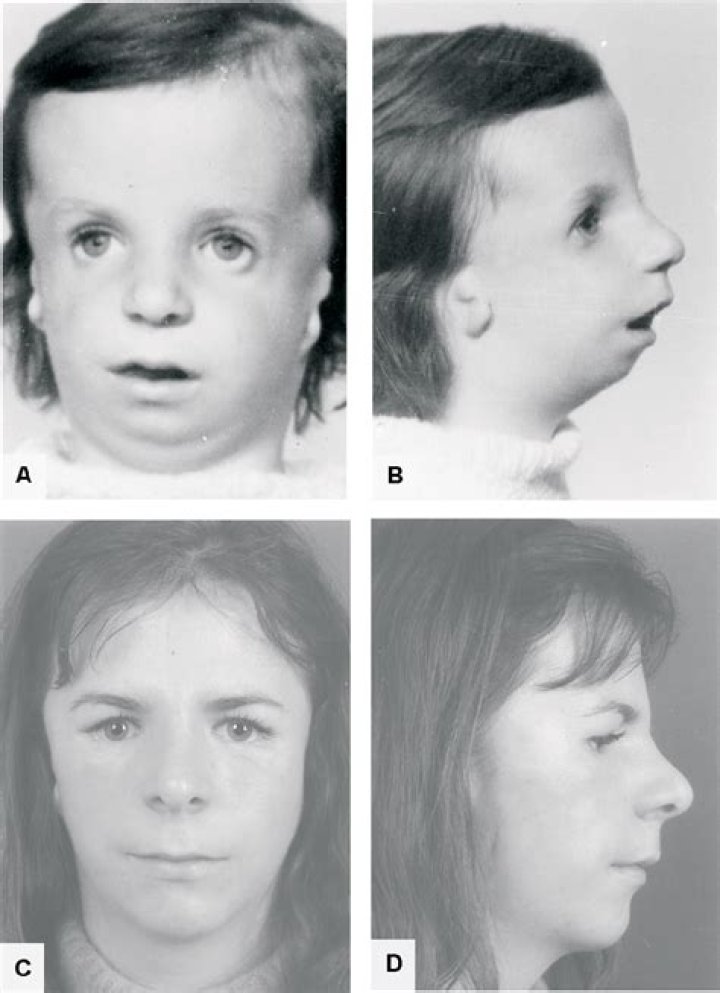 Treacher Collins Syndrome Before And After